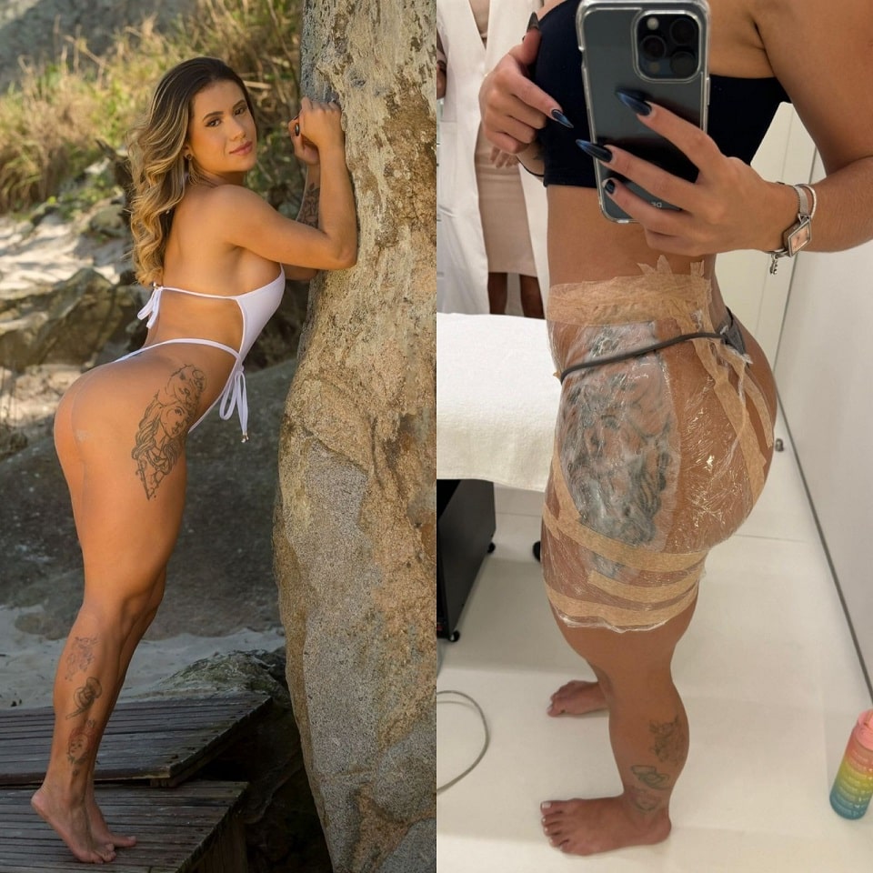 Atual campeã do Miss Bumbum, Larissa Sumpani, investe R$17 mil em  procedimento para retirada de tatuagem na coxa