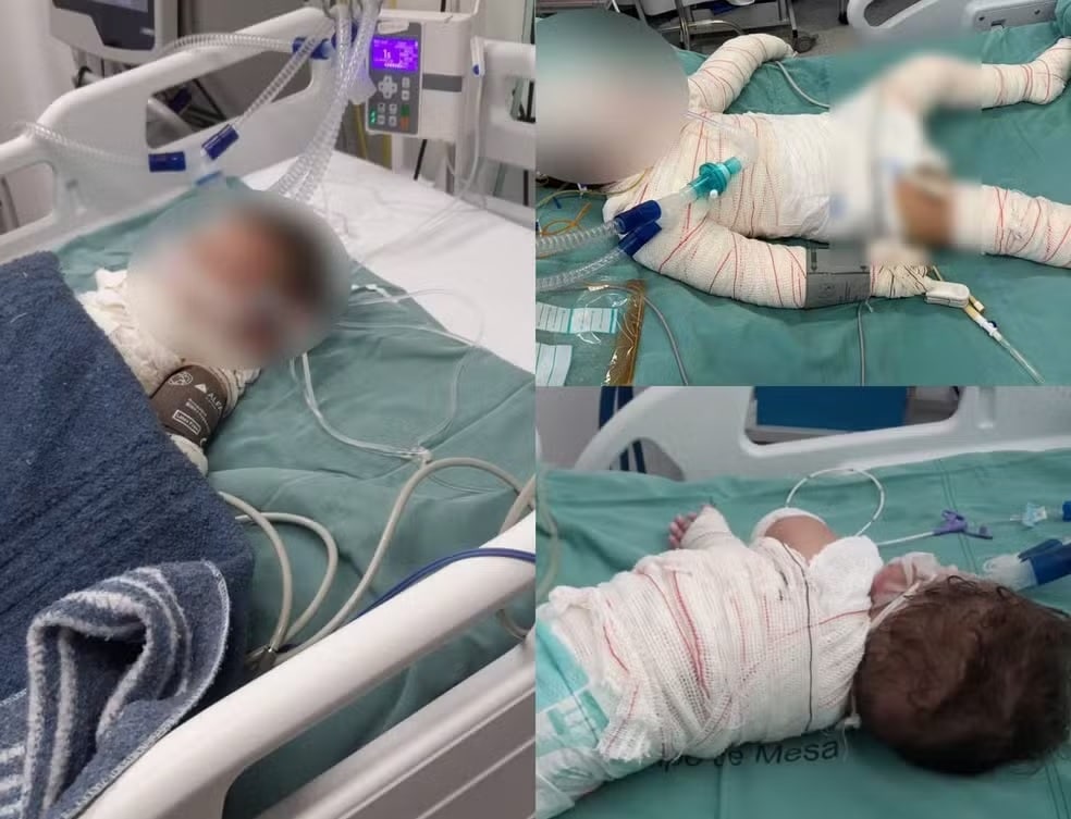 Morre o bebê de 1 ano após ser atingido por chamas de churrasqueira em MT