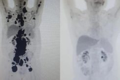 Exames mostram antes e depois de câncer de paciente; à direita, imagem mostra remissão da doença — Foto: Arquivo pessoal