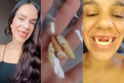 Aline Ferreira de Oliveira perdeu os dentes em um acidente de moto em Santos (SP) — Foto: Arquivo Pessoal